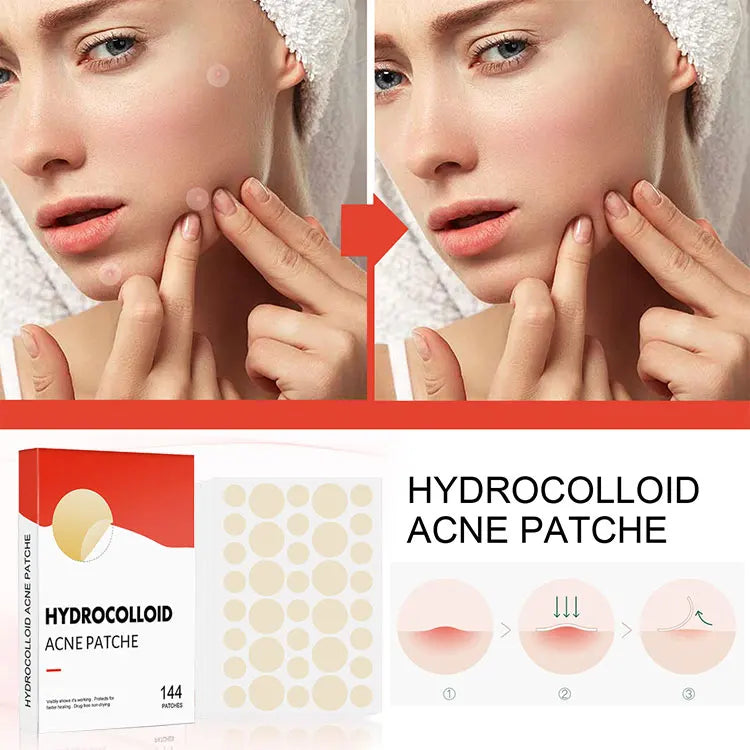 144pcs Acne Pimple Patch Set – Invisible Spot Stickers in 2 Sizes