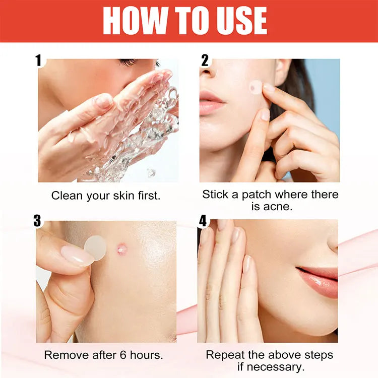 144pcs Acne Pimple Patch Set – Invisible Spot Stickers in 2 Sizes