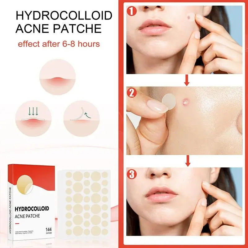 144pcs Acne Pimple Patch Set – Invisible Spot Stickers in 2 Sizes