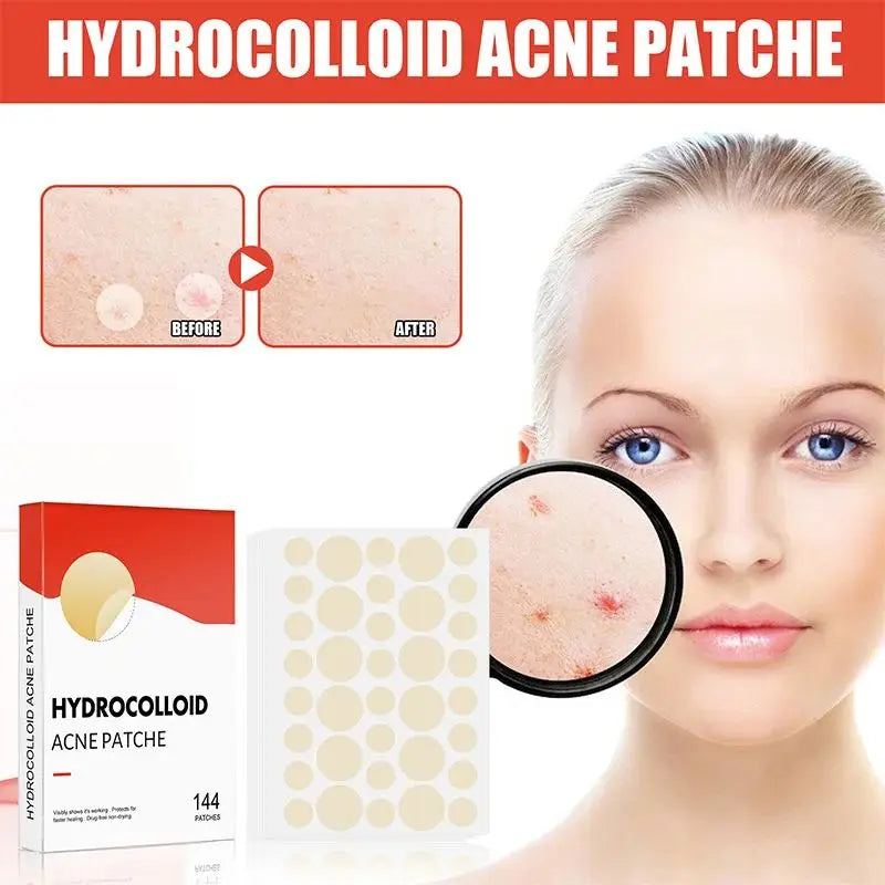 144pcs Acne Pimple Patch Set – Invisible Spot Stickers in 2 Sizes