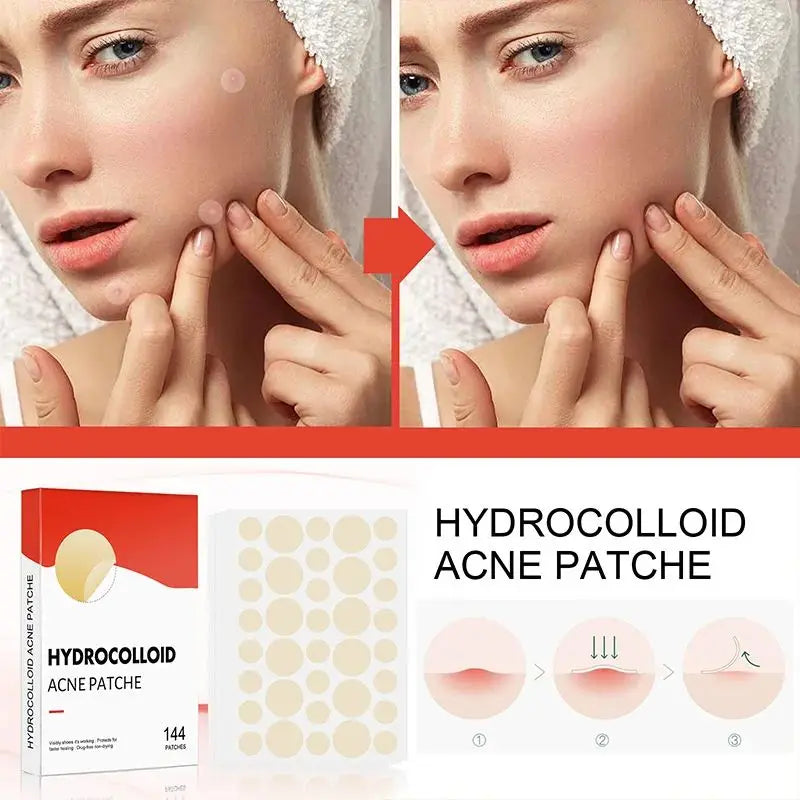 144pcs Acne Pimple Patch Set – Invisible Spot Stickers in 2 Sizes