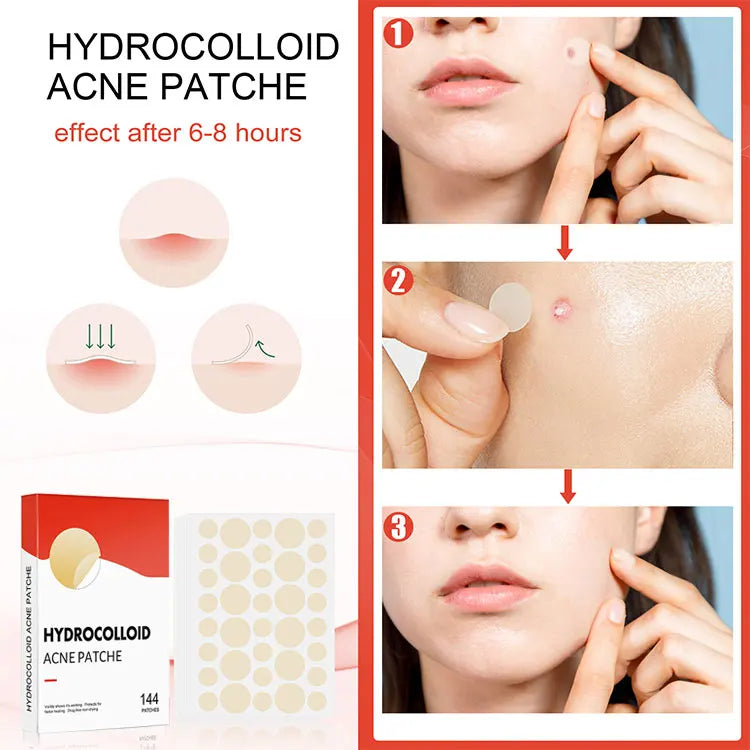144pcs Acne Pimple Patch Set – Invisible Spot Stickers in 2 Sizes